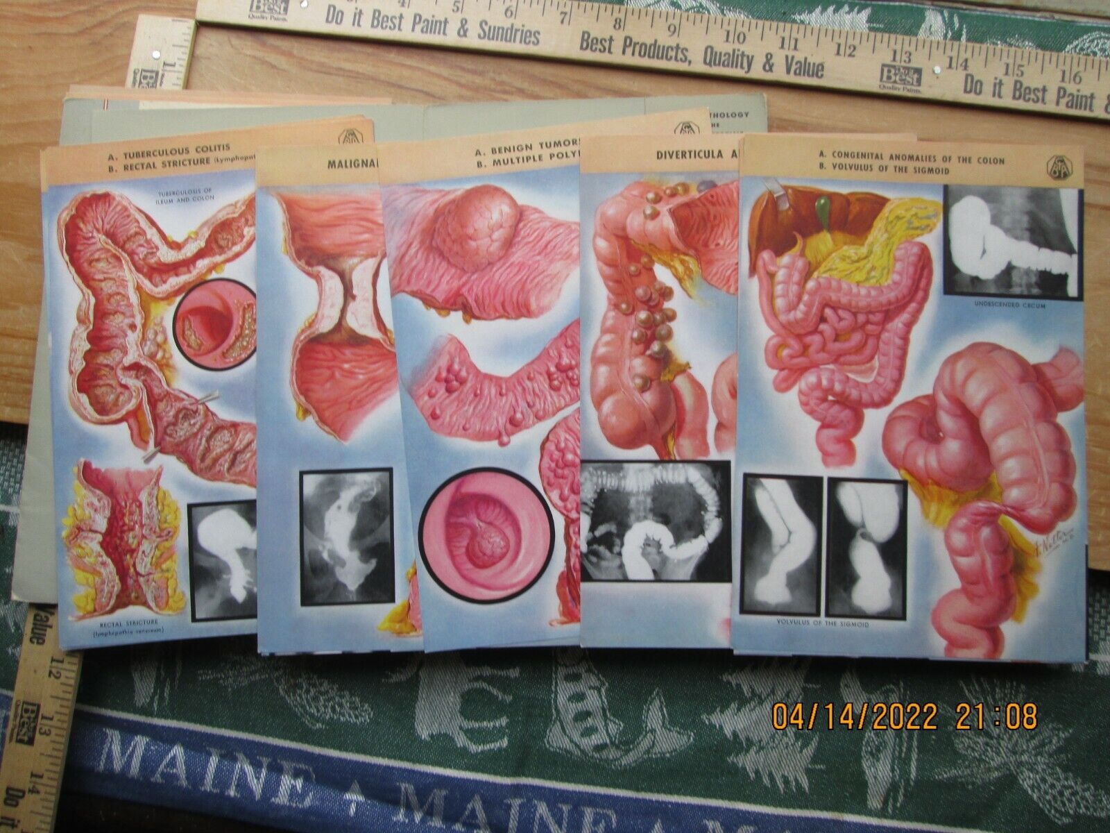 CIBA Pharmaceutical major pathology of the large intestines series one & two