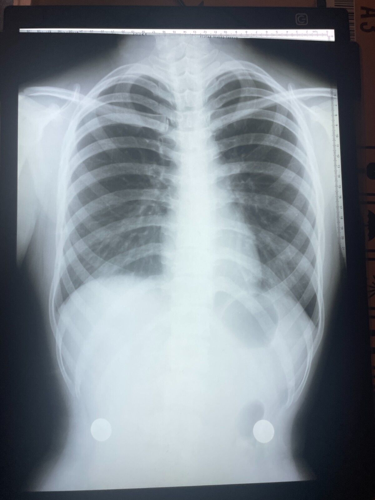 Eight (8) Vintage X-Ray Photograph Human Rib Cage Chest Abdomen Medical 1970\'s
