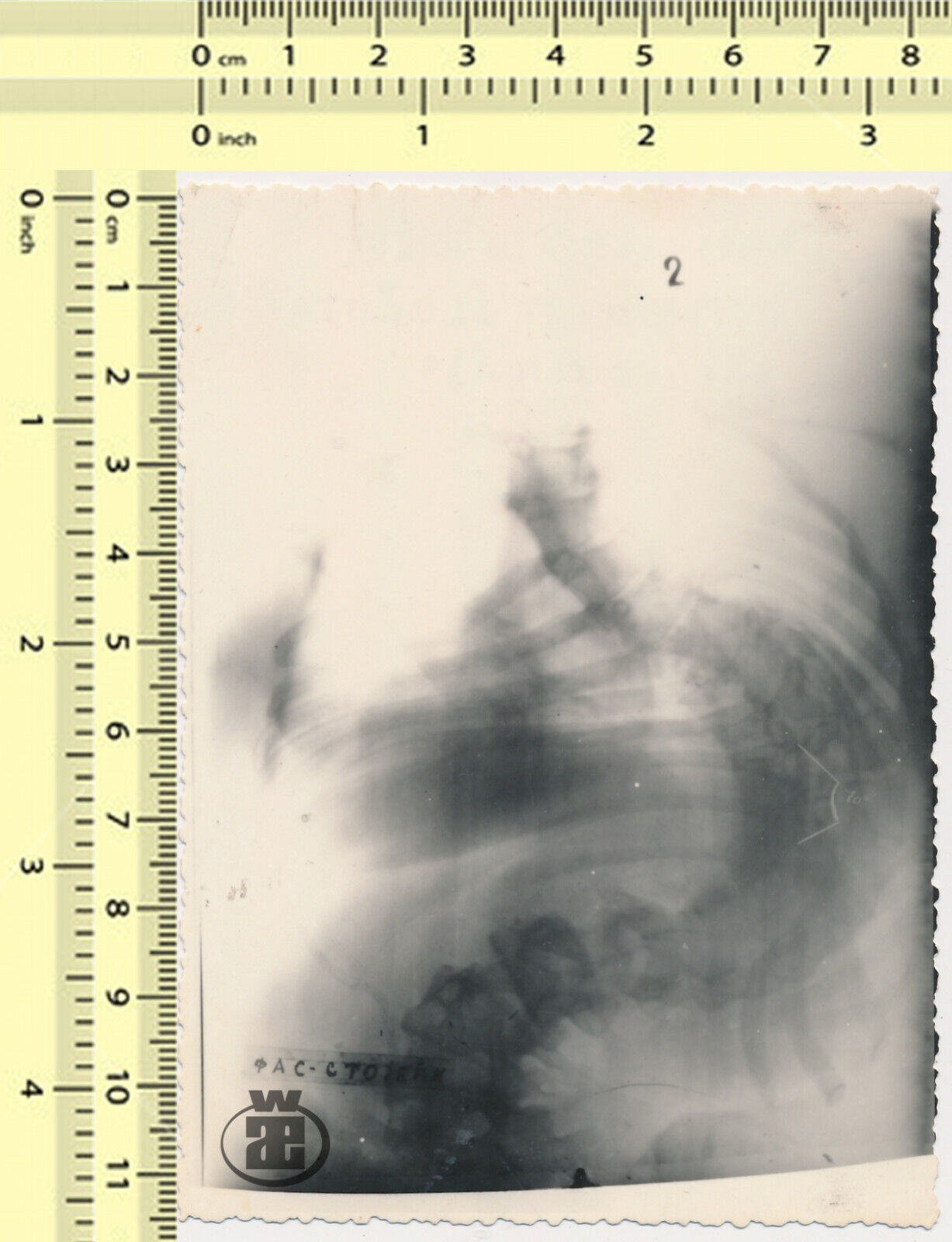 160 Radiography Deformity X-Ray Abstract Surreal Spine Bones vintage photo orig.