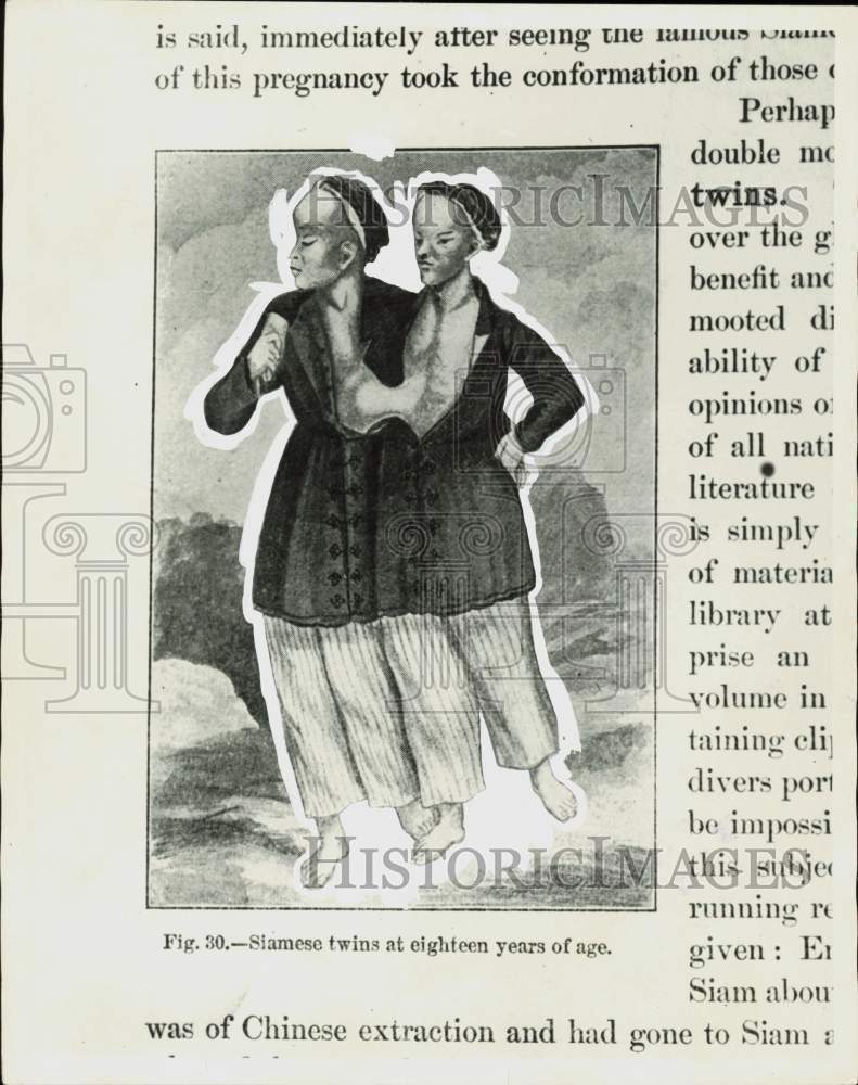 1928 Press Photo Drawing of Siamese twins at eighteen years of age - nei51284
