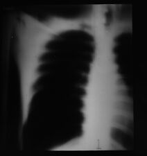 XRAY OF A HUMAN CHEST NO6 C1950 Magic Lantern Slide MEDICAL DOCTORS PHOTO picture