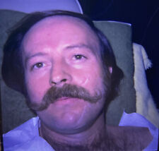 Vintage Photo Slide 1975 Man Mustache Face Scar Post Operation picture