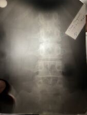 RARE 1932 VINTAGE HOSPITAL X-RAY /SPINE/BACK/DOCTOR/ODDITIES/BIZARRE/PAIN 👀LQQK picture