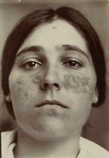 1906 Young Woman with Lupus Citrate Photograph by Dr. Bovin picture